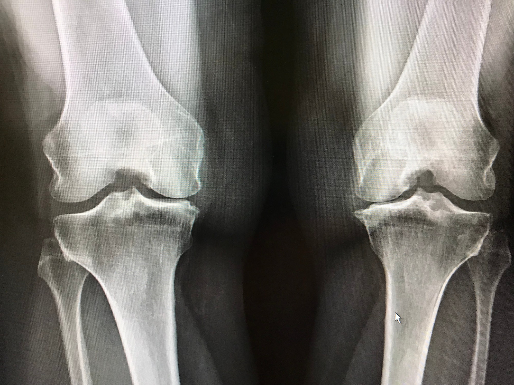 Xray shows narrowing of bones at the knees, cartilage loss, Spurs and calluses with osteoarthritis