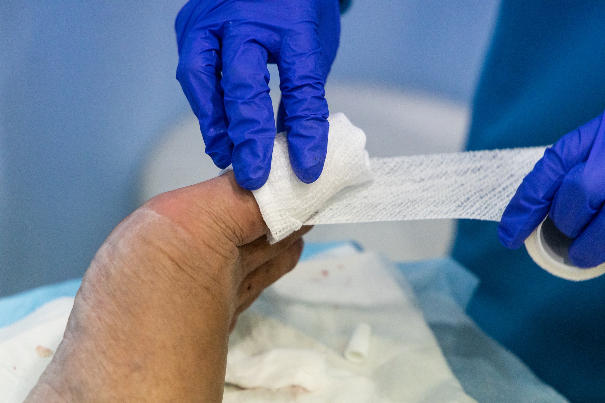 Healthcare worker nursing toe with bandage gauz after ingrown toenail surgery